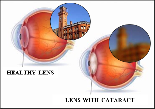 cataract1