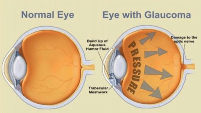 Glaucoma1