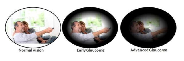 Glaucoma2