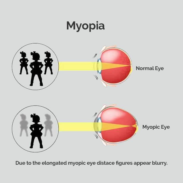 MYOPIA1